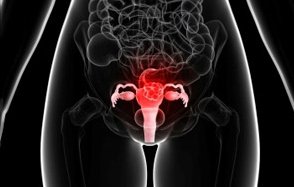 Cervical Cancer NET OK 2