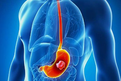 cancer gastrico NET OK