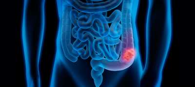 colorretal 2018 NET OK