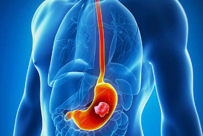 cancer gastrico NET OK