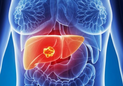 metastase hepatica bx