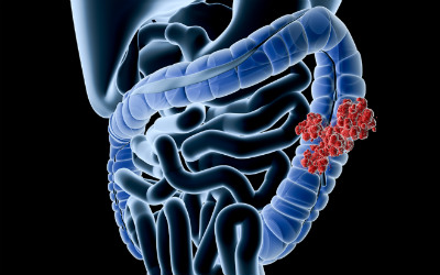 polipos colorretal bx