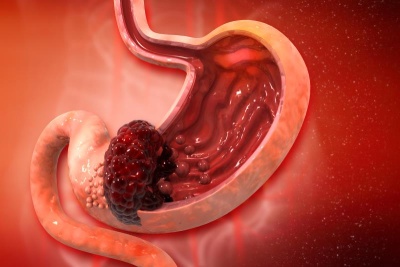 cancer gastrico 21 bx