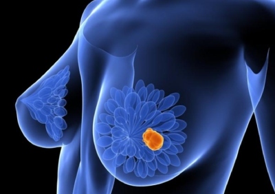 cáncer de mama 2021 bx