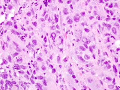 melanoma mucosa