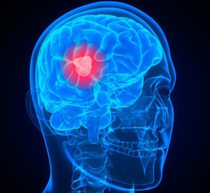 Glioblastoma_ESMO_Imuno_NET_OK.jpg