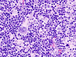 Hodgkin_lymphoma__1__mixed_cellulary_type_NET_OK.jpg