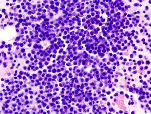 Multiple_myeloma__2__HE_stain_NET_OK.jpg