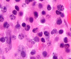 multiple_myeloma_NET_OK.jpg